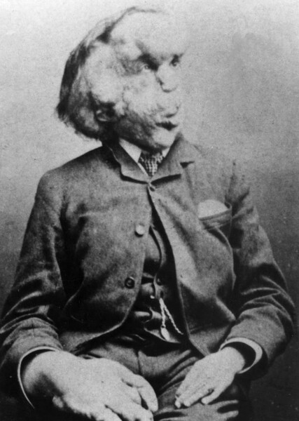 Joseph Merrick (The Elephant Man)