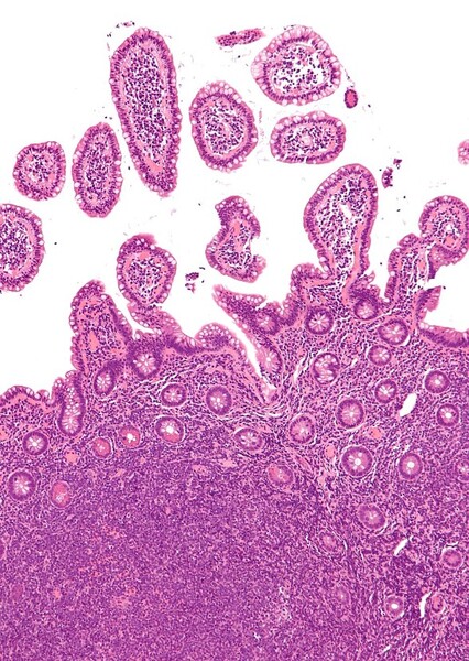 Non-Hodgkin lymphoma
