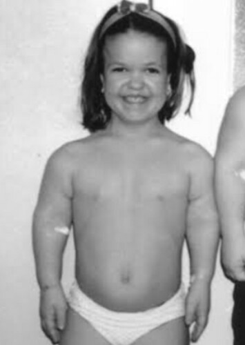 Dwarfism (F)