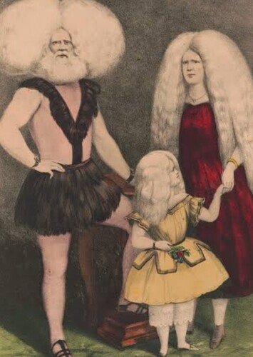 Albinism