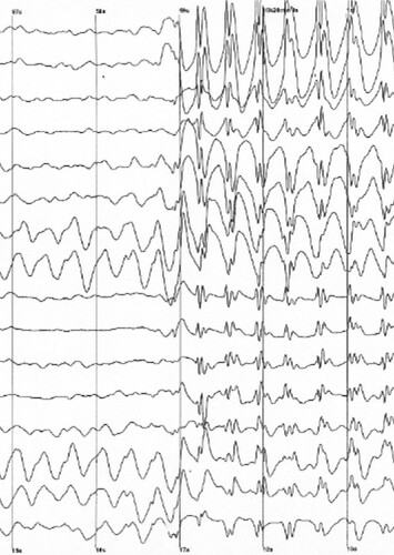 EEG Brain Scan