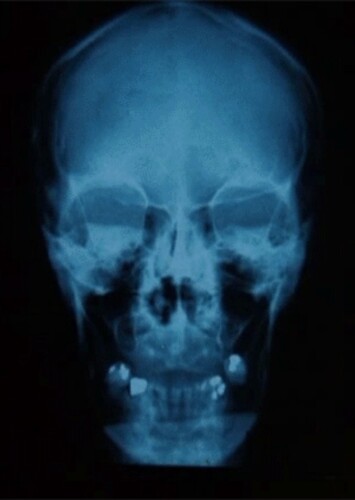 Radiology X-Ray Skull