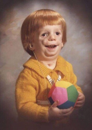 Treacher Collins Syndrome