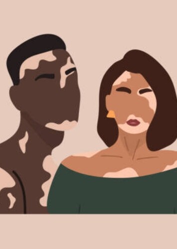Vitiligo