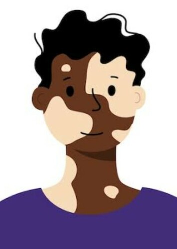 Vitiligo (M)