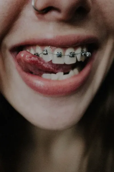 Braces